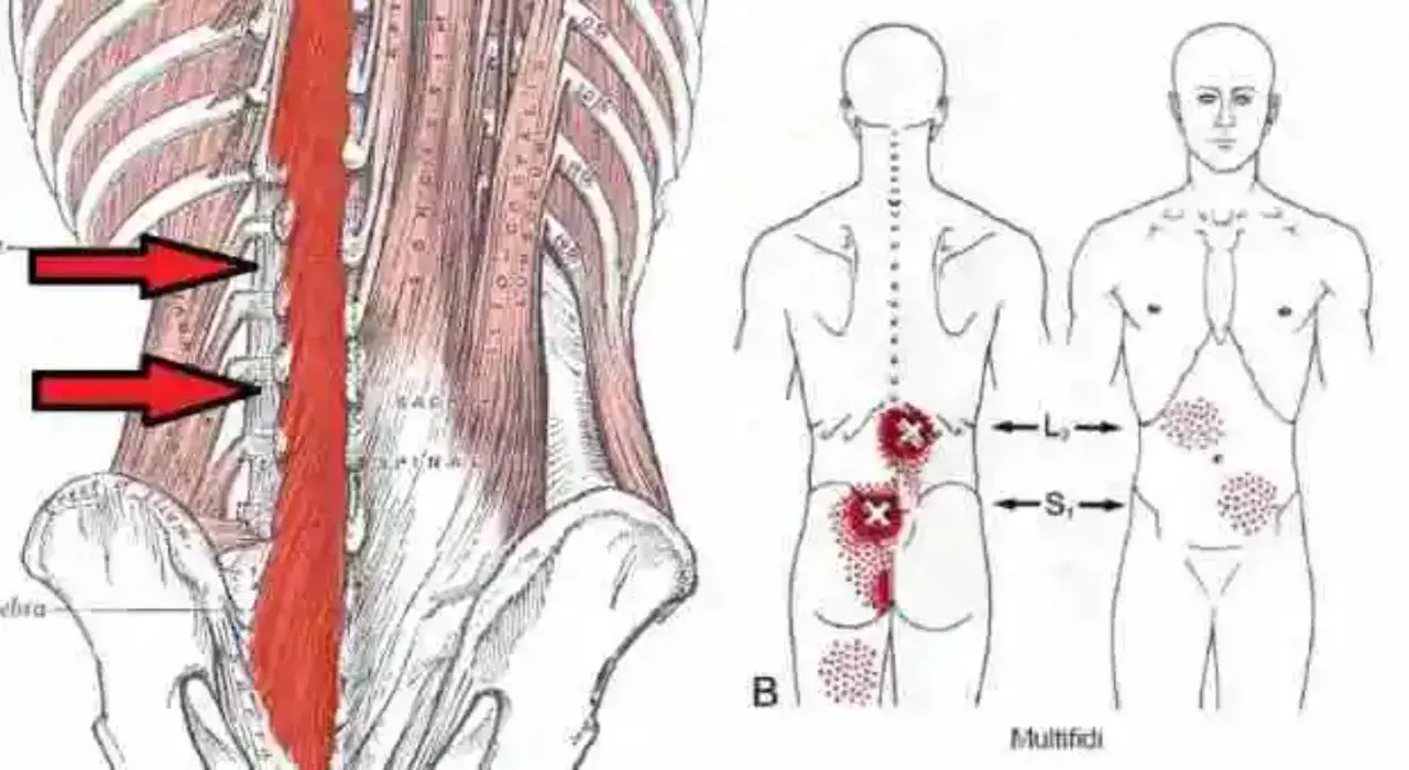 Anatomía de la espalda con flechas rojas señalando la zona afectada por un posible desgarro muscular espalda. Puntos rojos indican dolor.