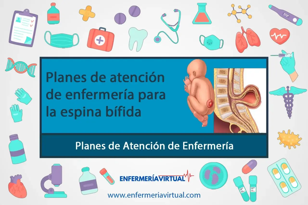 Ilustración de un bebé con espina bífida y su columna vertebral. El texto indica "Planes de atención de enfermería para la espina bífida".