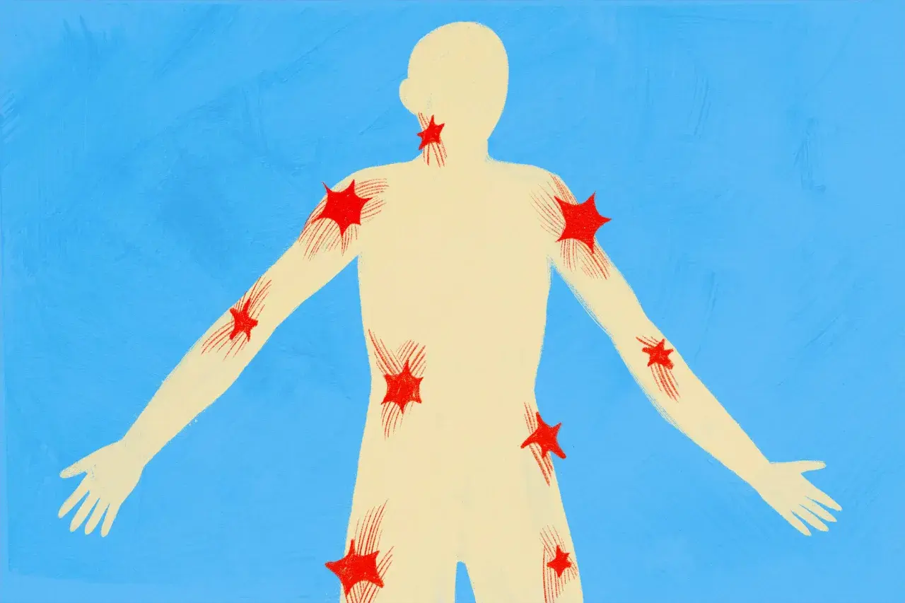 Silueta humana con puntos rojos que representan qué son los puntos gatillo, distribuidos en cuello, hombros, brazos y torso.