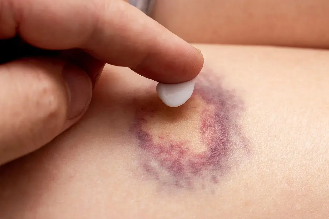 Dedo aplica crema sobre un moretón morado. Descubre cómo quitar moretones en minutos con este método.