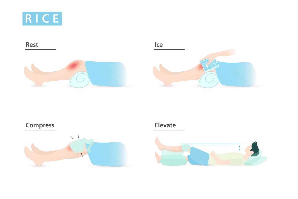 Ilustración del método RICE: reposo, hielo, compresión y elevación para tratar lesiones.