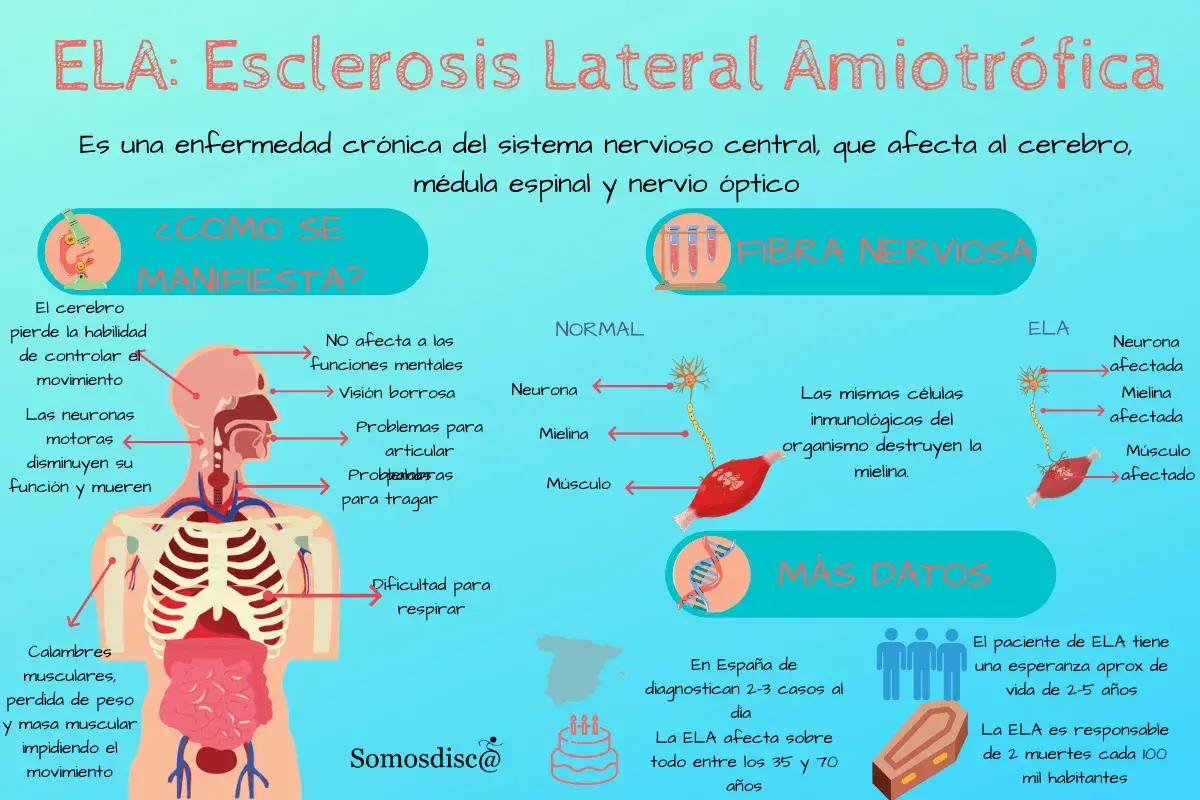 Infografía sobre la ELA, mostrando sus primeros síntomas como pérdida de control del movimiento, calambres y dificultad para respirar.