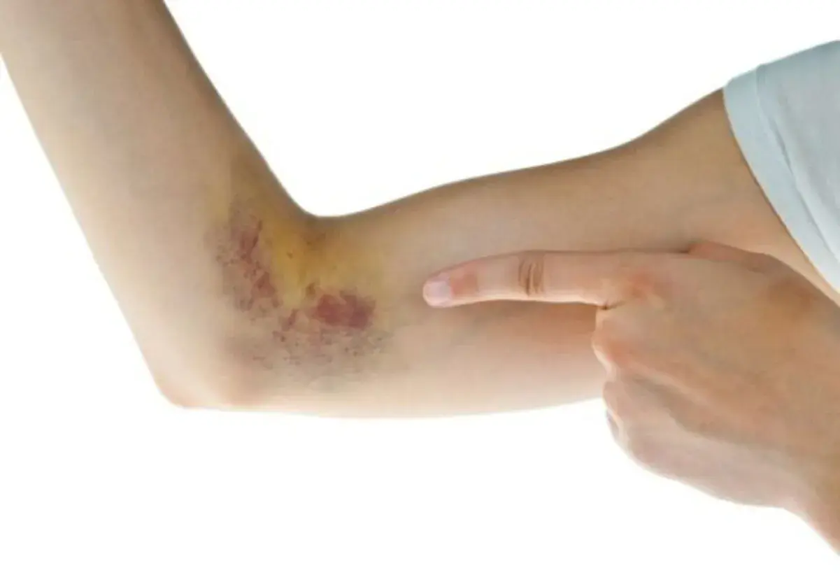 Brazo con hematoma, sangre coagulada bajo la piel como quitar.