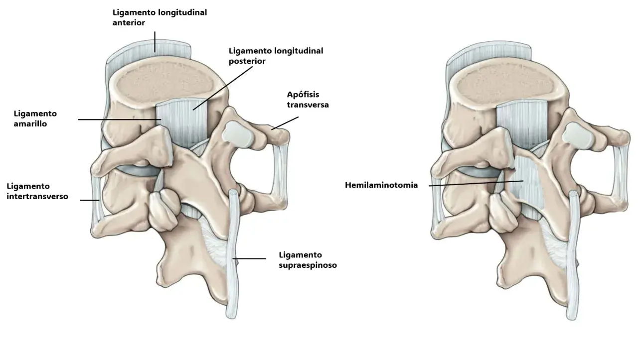 Ilustración de la anatomía lumbar antes y después de una hemilaminectomía, mostrando ligamentos y apófisis.