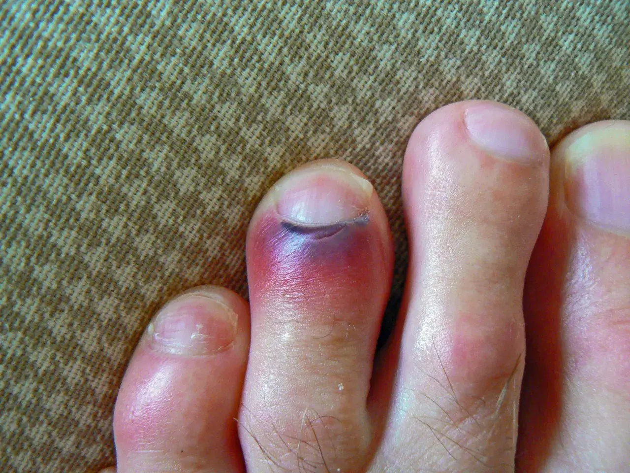 Un dedo del pie con un gran hematoma morado y rojo, indicando una lesión.