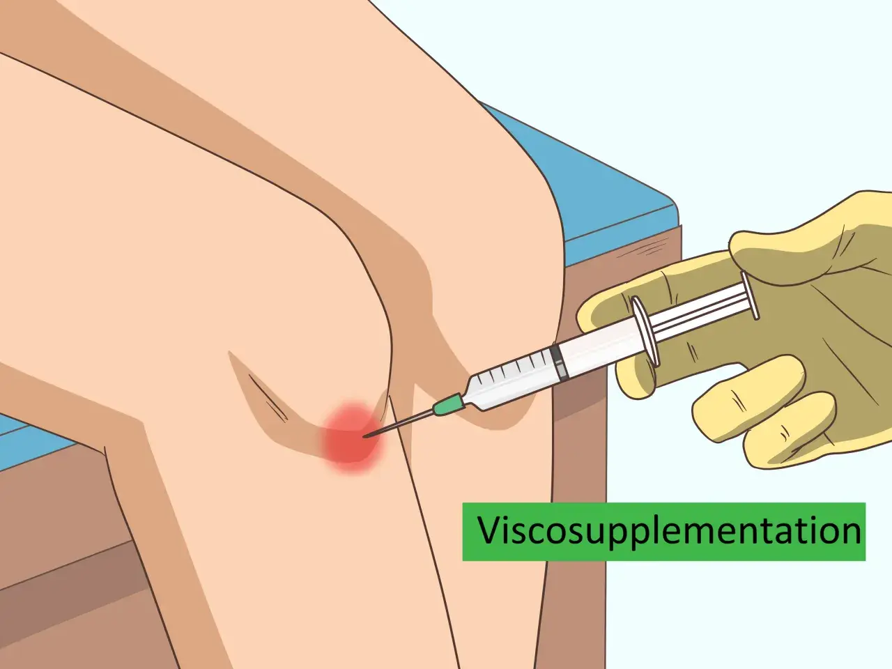 Inyección de líquido sinovial en la rodilla para aliviar el dolor.