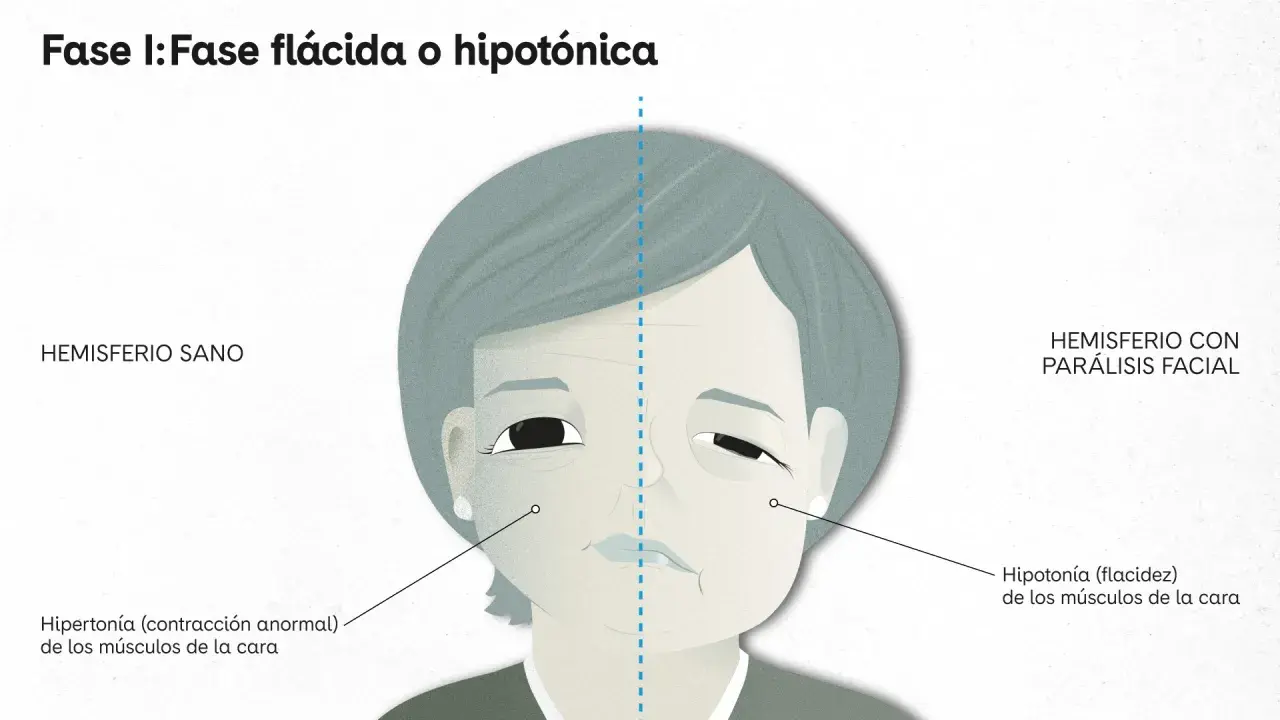 Ilustración comparativa de un rostro con parálisis facial. Un lado muestra un hemisferio sano, el otro un hemisferio con parálisis facial, con hipotonía.