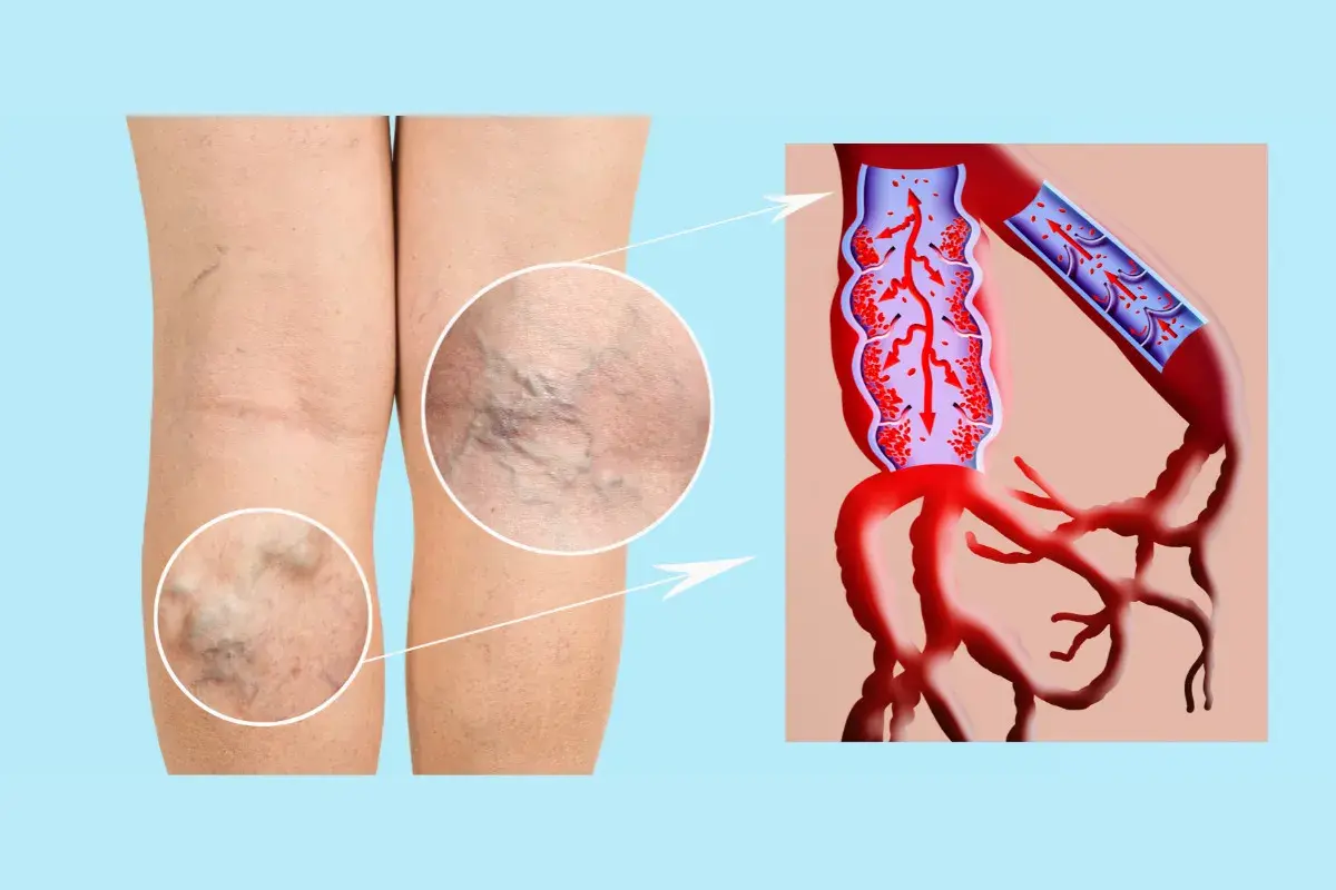 Piernas con várices y detalle de insuficiencia venosa, mostrando el flujo sanguíneo alterado en las venas.