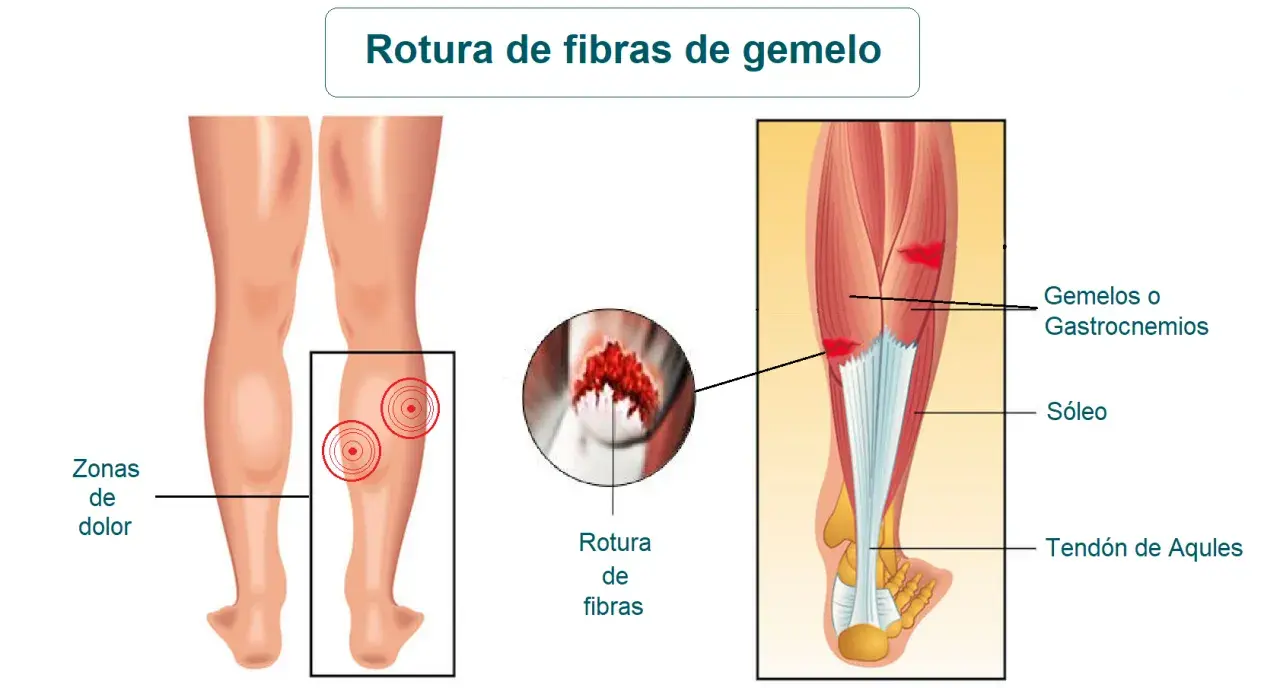 Ilustración médica de una rotura de fibras del gemelo, mostrando zonas de dolor y la anatomía muscular de la pantorrilla.