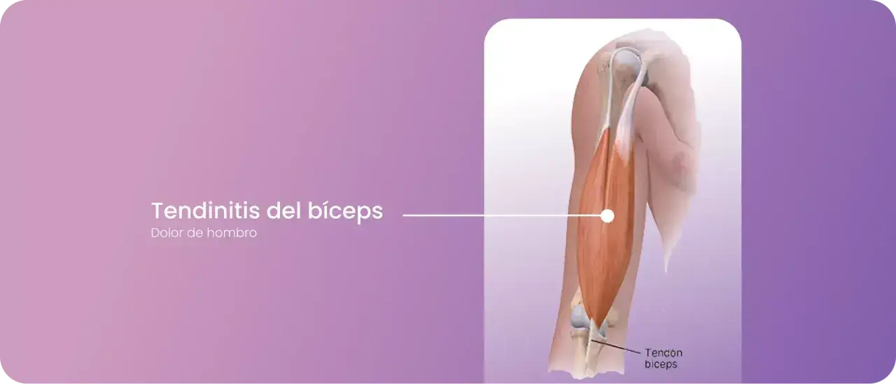 Ilustración de tendinitis del bíceps, mostrando el músculo y el tendón del bíceps.