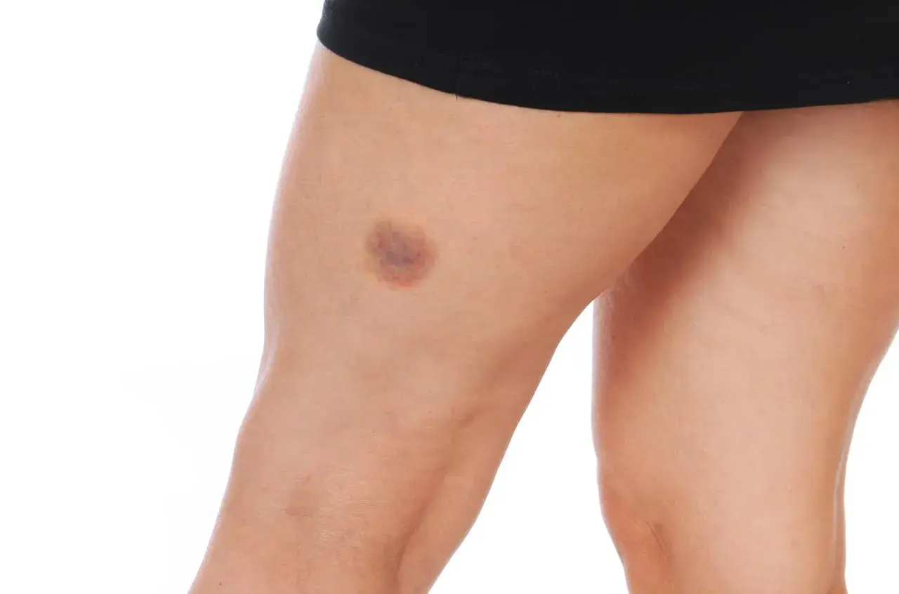 Pierna con moretones por golpes, evidencia de un impacto.