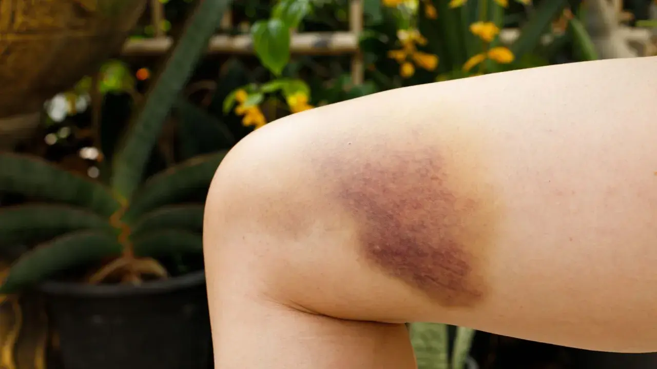 Pierna con un gran hematoma oseo, morado y amarillento, resultado de un golpe.