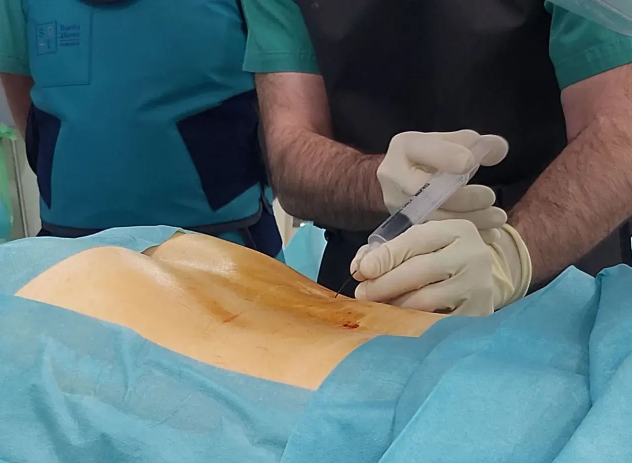 Procedimiento médico de ozonoterapia para tratar una hernia discal. Un profesional sanitario administra una inyección en la zona lumbar.