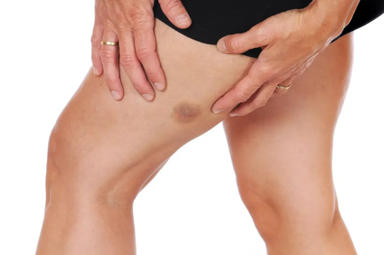 Un hematoma en el muslo, visible bajo la piel, con manos que lo sujetan suavemente.