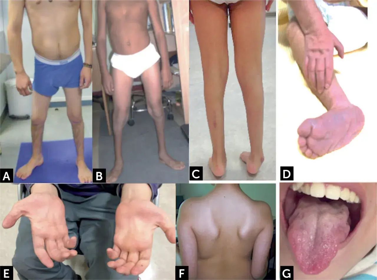 Manifestaciones de atrofia muscular espinal: piernas delgadas (A, B, C), pie equino (D), manos con dedos finos (E), espalda con escápulas prominentes (F) y lengua con fasciculaciones (G).
