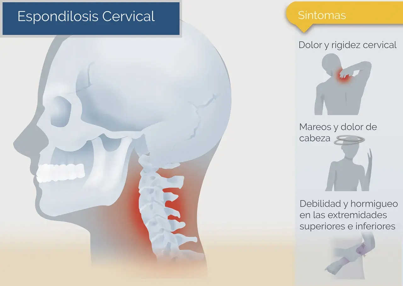 Ilustración de la columna cervical con zonas de dolor, junto a iconos de síntomas.