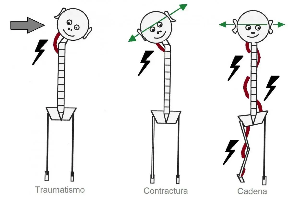 Ilustración muestra cómo un traumatismo, contractura o una cadena de tensiones musculares afectan la postura y el cuerpo.