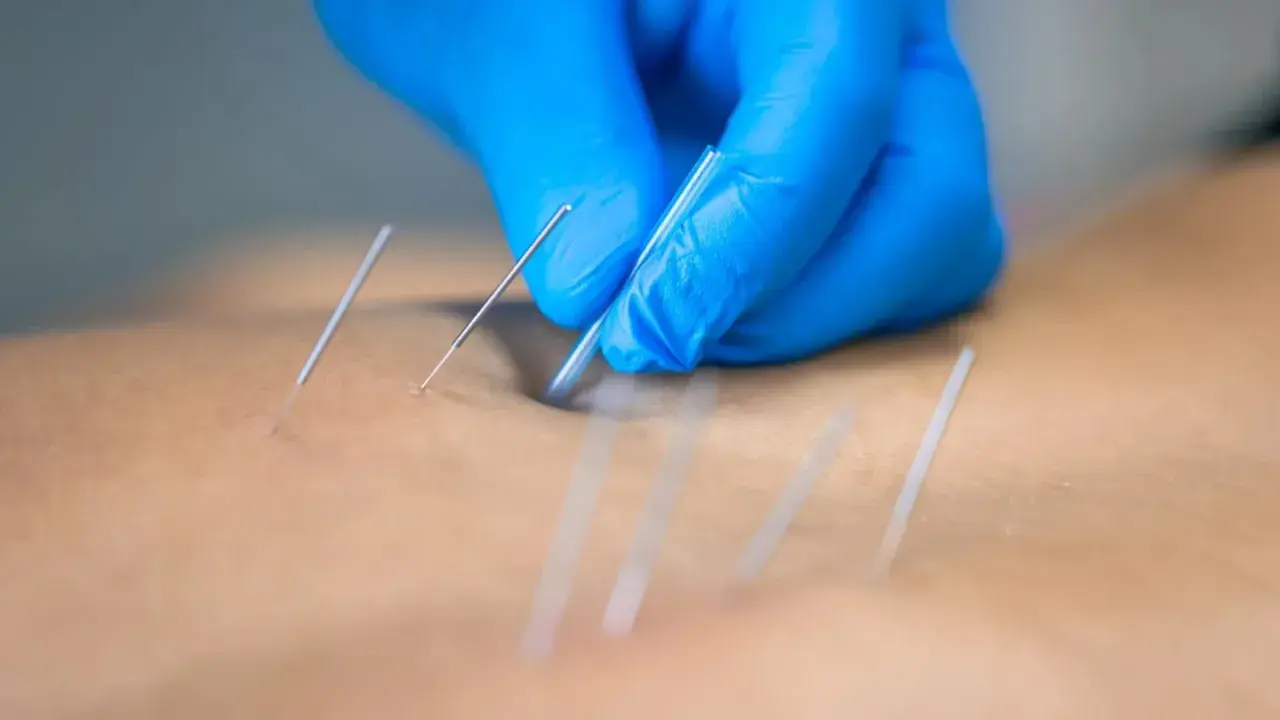 Manos enguantadas aplican agujas para punción seca, aliviando una contractura muscular.