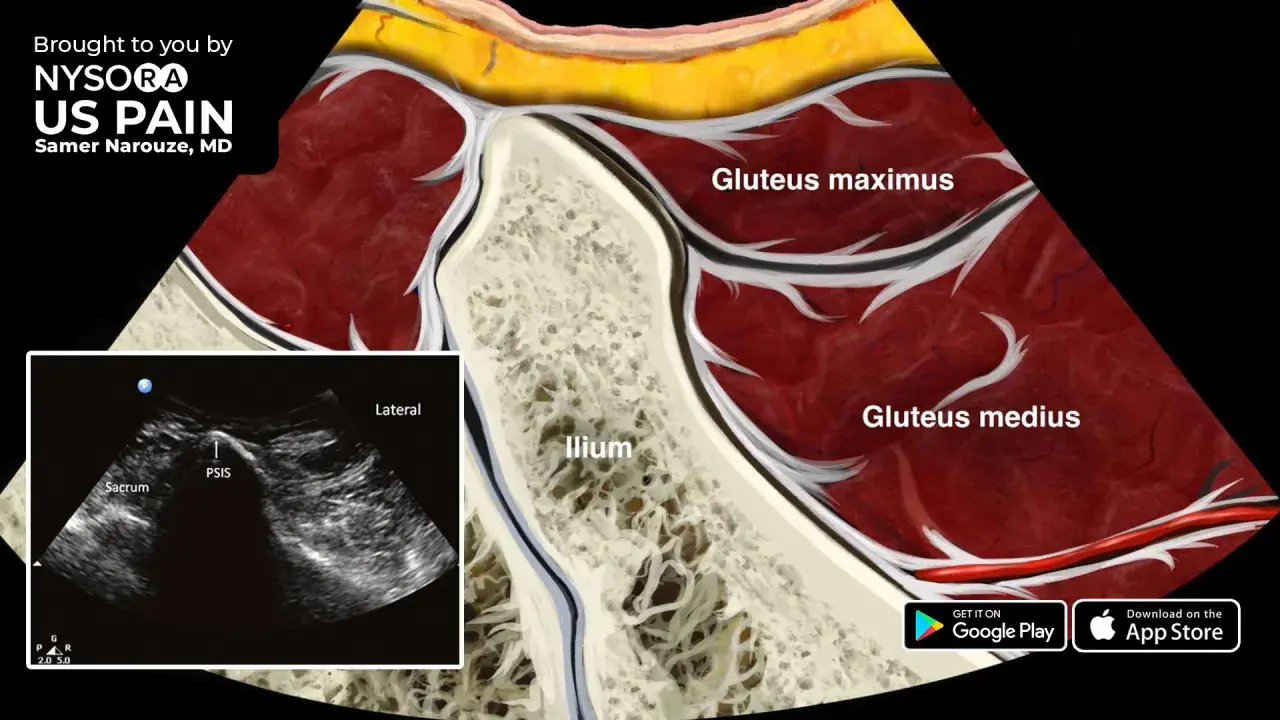 Anatomía de la pelvis y glúteos, mostrando el ilion, glúteo mayor y medio. Ecografía de la zona del PSIS y sacro, útil para diagnosticar el síndrome piriforme.