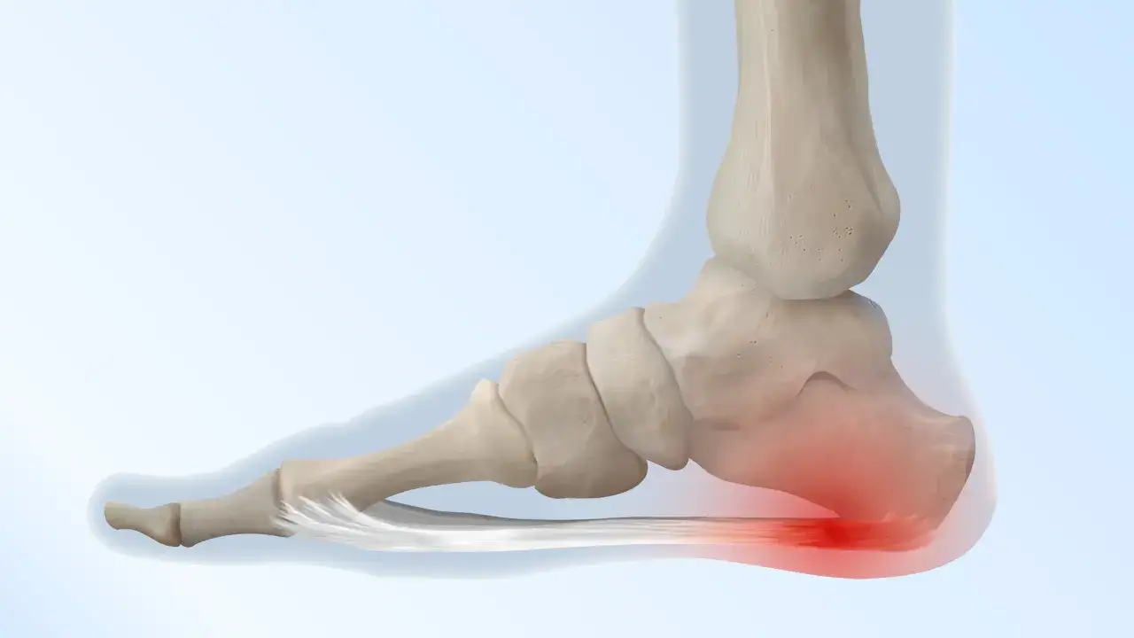 Anatom&iacute;a del pie con &aacute;rea roja en el tal&oacute;n, indicando dolor de pies.