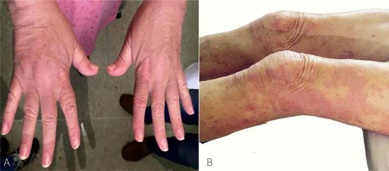 Manos con erupción y rodillas enrojecidas, síntomas de miositis que es una inflamación muscular.