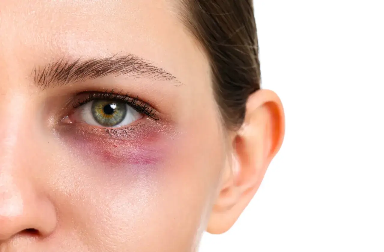 Ojo morado por golpe, buscando un remedio casero para aliviar la hinchaz&oacute;n y el dolor.