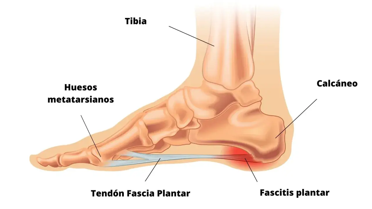 Ilustración anatómica del pie, mostrando la tibia, calcáneo, huesos metatarsianos y el tendón de la fascia plantar, con área de fascitis plantar resaltada en rojo.