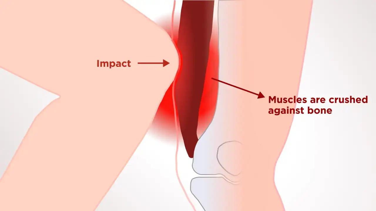 Impacto en el muslo causa hematoma. Los m&uacute;sculos se aplastan contra el hueso, provocando dolor e inflamaci&oacute;n.