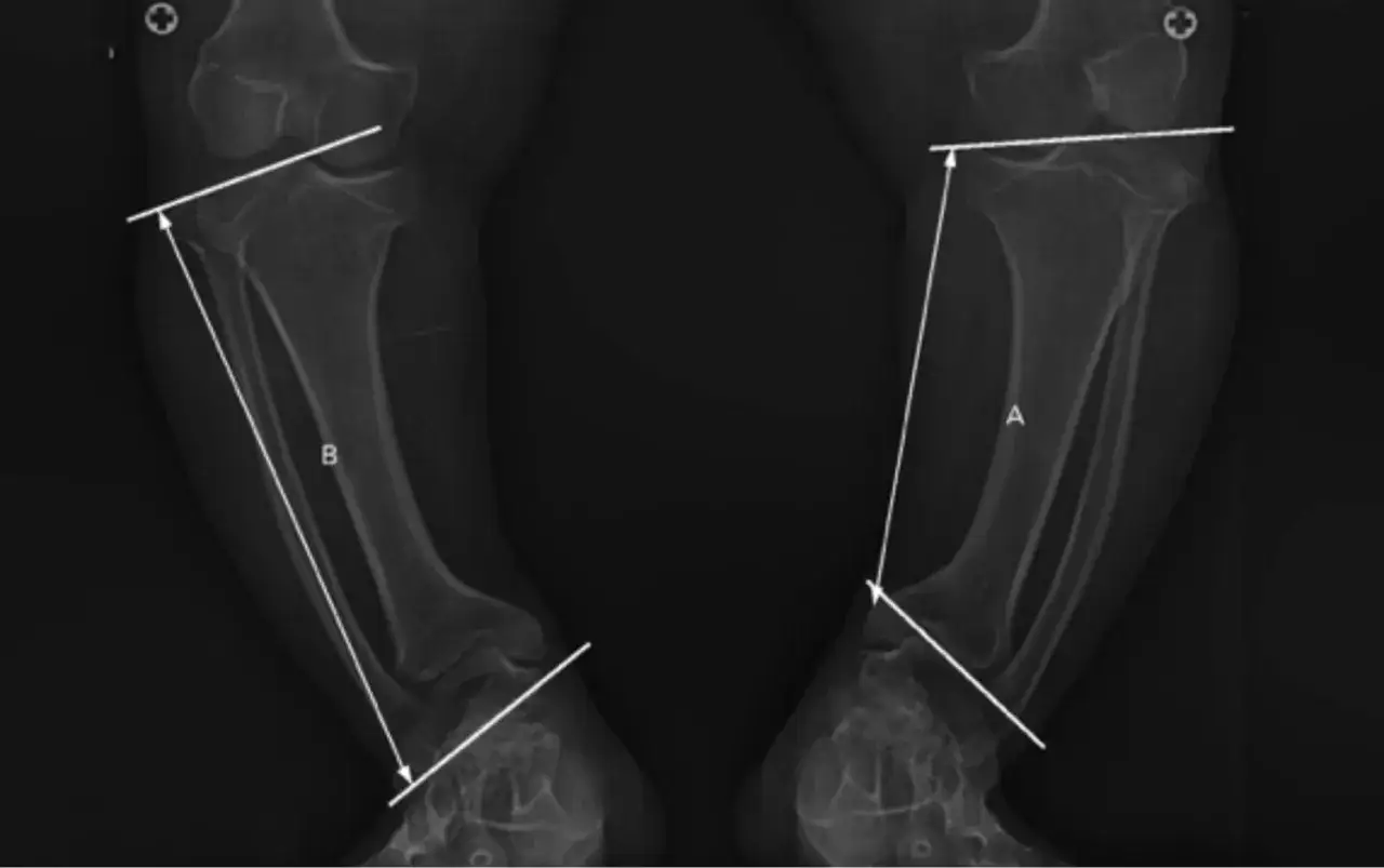 Radiografías de piernas con mediciones. Podrían ser útiles para entender la acondroplasia que es.