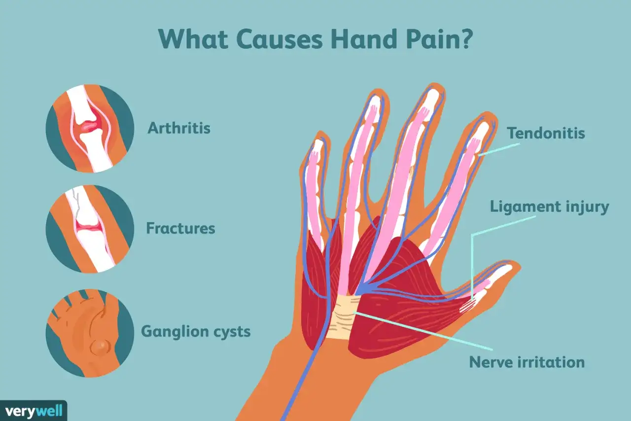 Ilustraci&oacute;n de la mano mostrando huesos, tendones y nervios, con etiquetas para artritis, fracturas, quistes ganglionares, tendinitis, lesi&oacute;n de ligamentos e irritaci&oacute;n nerviosa.