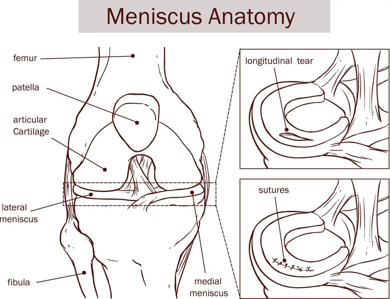 Anatom&iacute;a de la rodilla: f&eacute;mur, r&oacute;tula, meniscos y ligamento cruzado anterior. Muestra desgarro longitudinal y suturas.