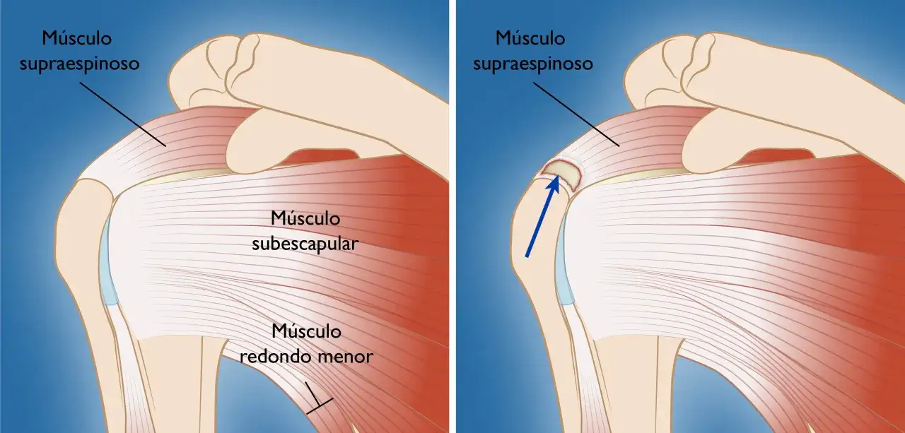 Ilustración de la anatomía del hombro, mostrando el músculo supraespinoso, subescapular y redondo menor. La imagen de la derecha destaca una posible lesión en el manguito rotador.