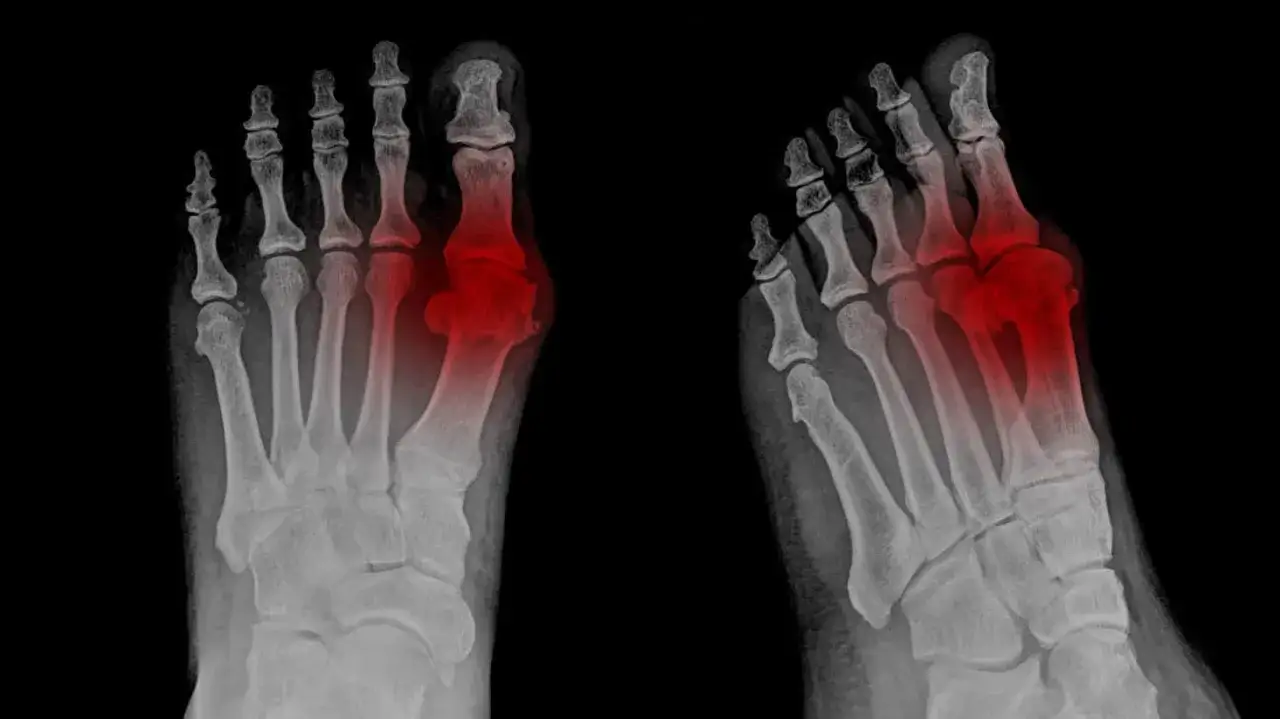 Radiografías de pies con zonas rojas que indican dolor pie lateral interno.