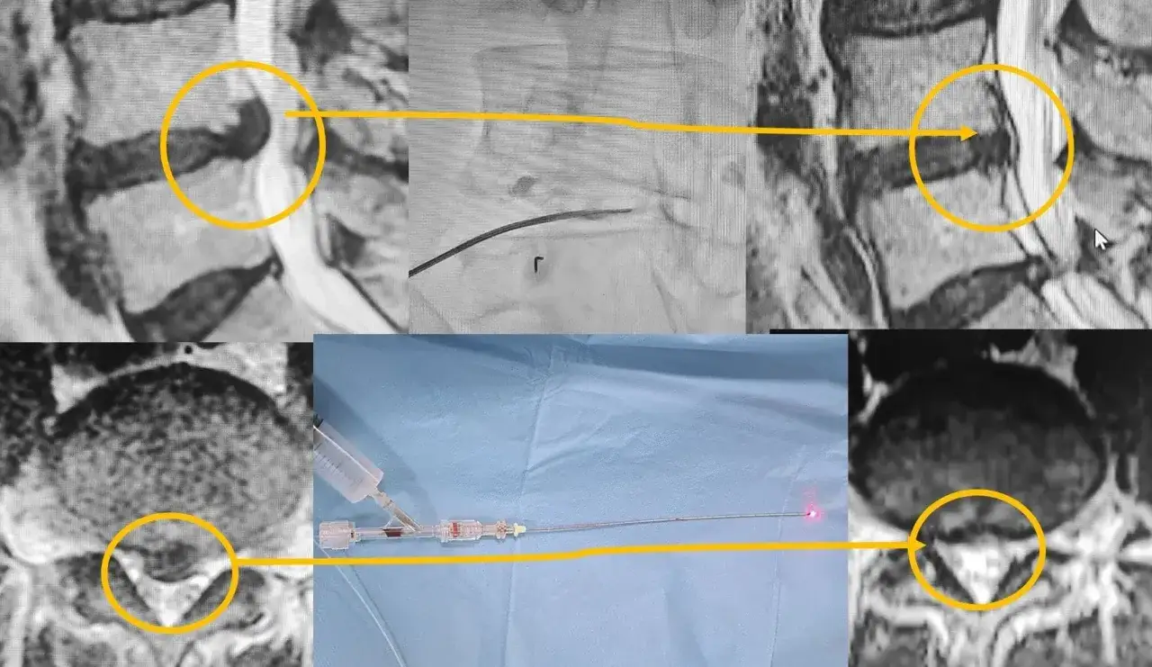 Im&aacute;genes de resonancia magn&eacute;tica y equipo m&eacute;dico para ozonoterapia hernia discal.