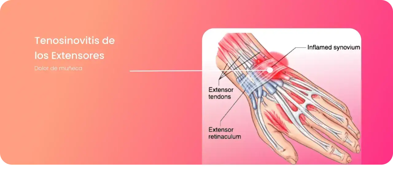 Ilustración de la tendinitis en la mano, mostrando tendones extensores inflamados y dolor de muñeca.