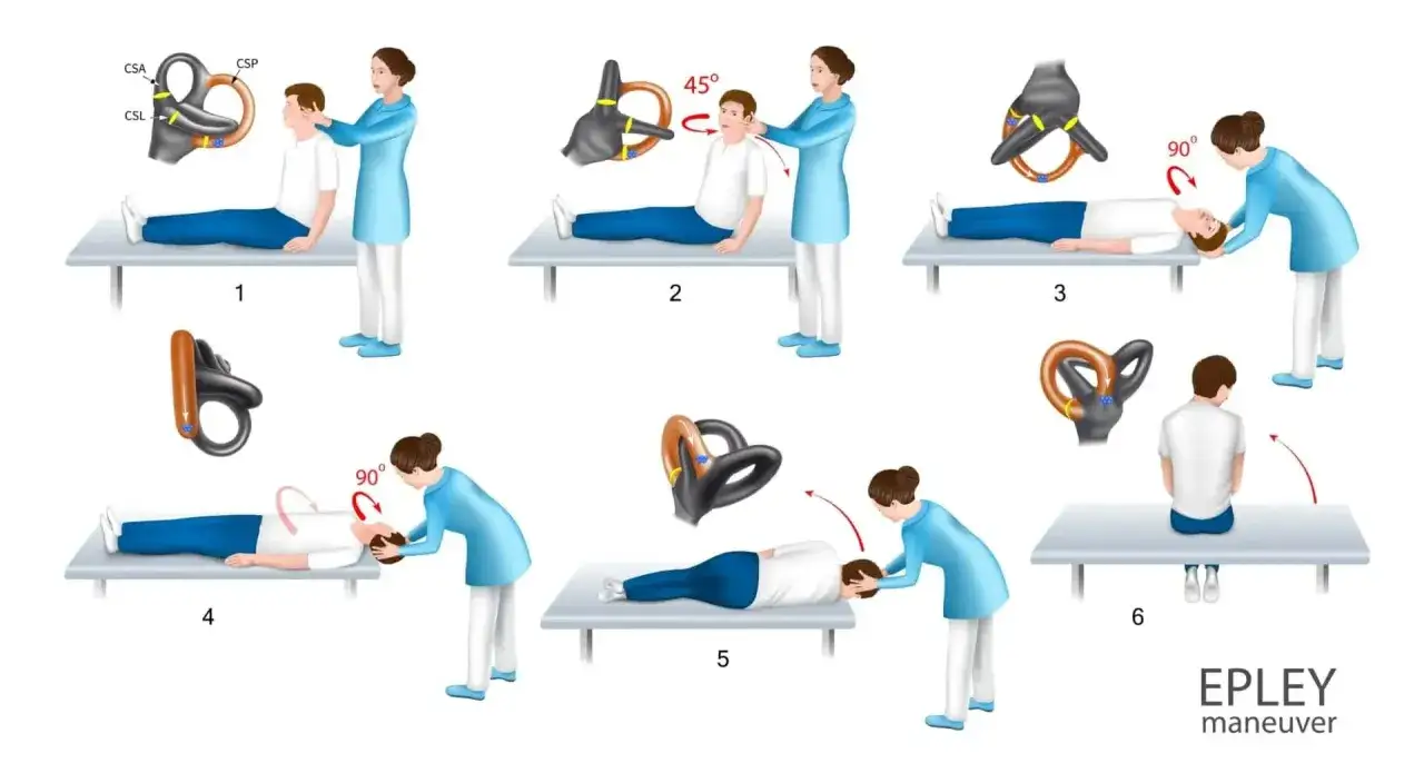 Secuencia de la maniobra de Epley para tratar el vértigo posicional paroxístico benigno. Ilustra los movimientos de cabeza y cuerpo.