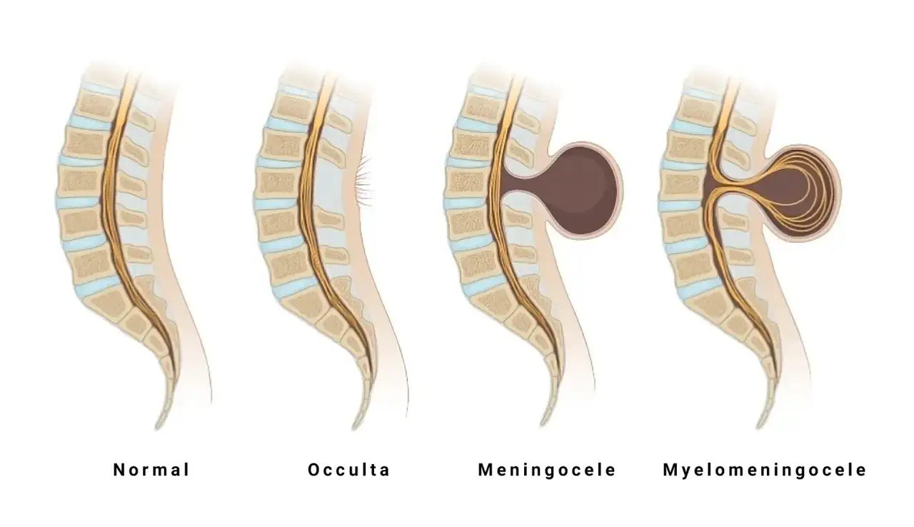 Ilustraci&oacute;n de la columna vertebral mostrando espina b&iacute;fida: normal, oculta, meningocele y mielomeningocele.