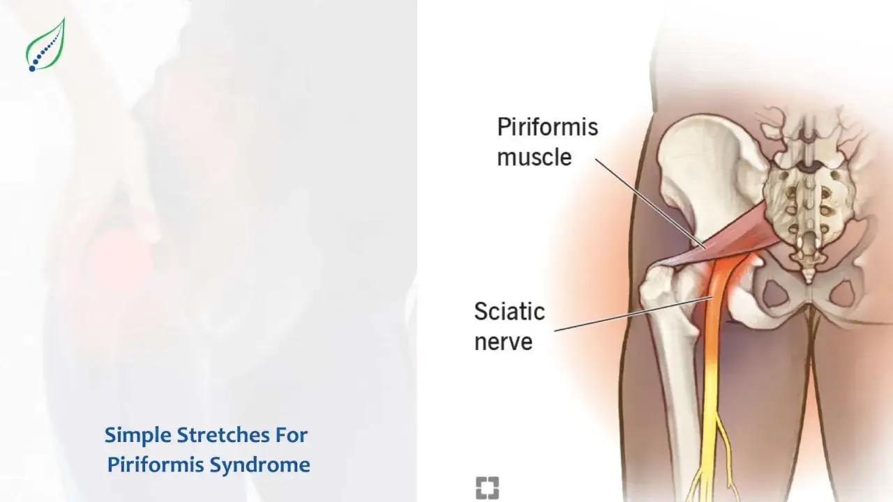 Anatom&iacute;a de la pelvis y el nervio ci&aacute;tico, mostrando c&oacute;mo el m&uacute;sculo piriforme puede comprimirlo, causa com&uacute;n del s&iacute;ndrome piriforme.