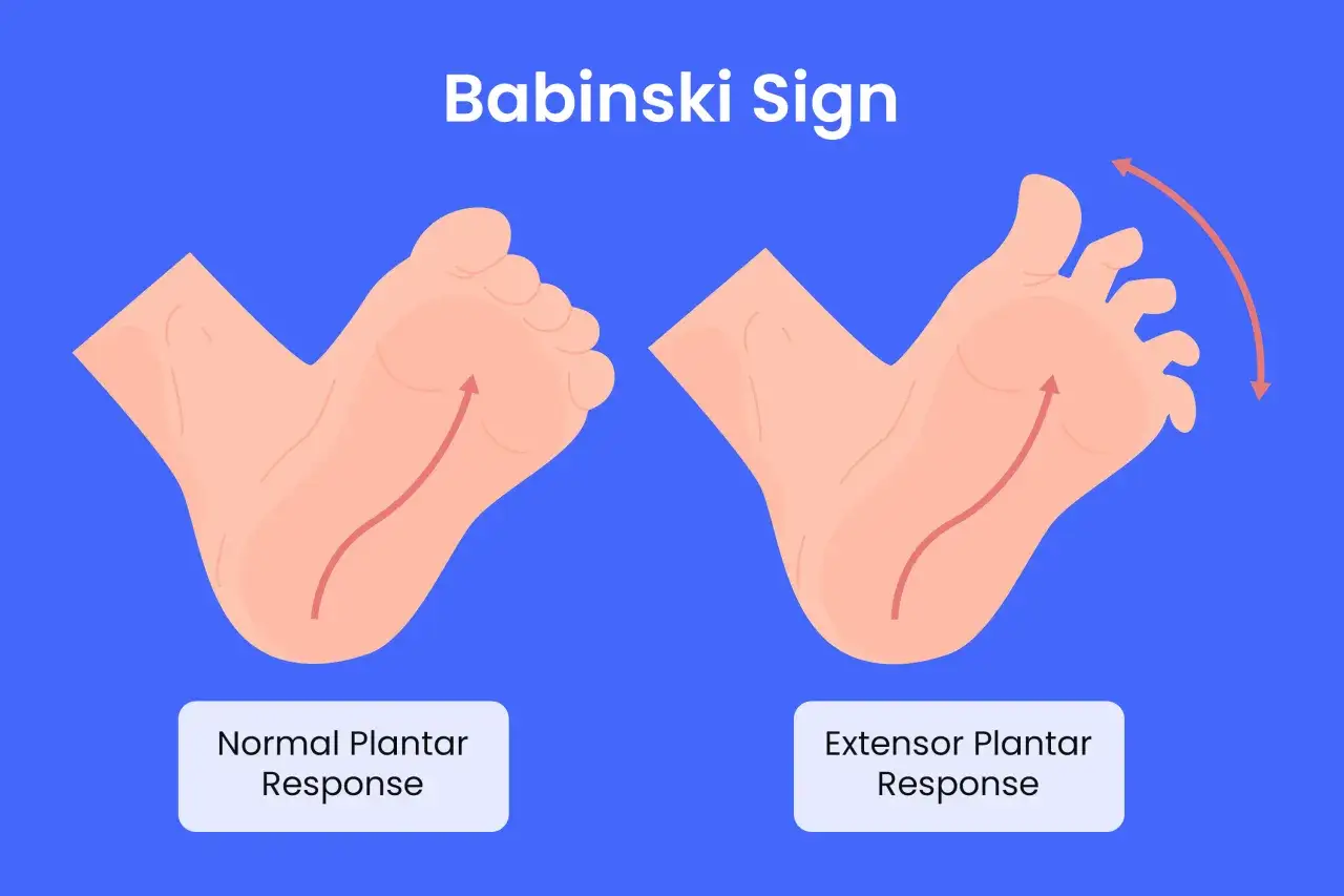 Ilustraci&oacute;n comparativa de la respuesta plantar normal (dedos flexionados) y la respuesta extensora plantar, que indica el reflejo de Babinski (dedos extendidos).