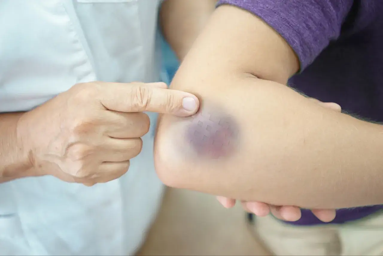 Un dedo se&ntilde;ala un moret&oacute;n en el codo, mostrando c&oacute;mo la sangre coagulada bajo la piel puede ser tratada.