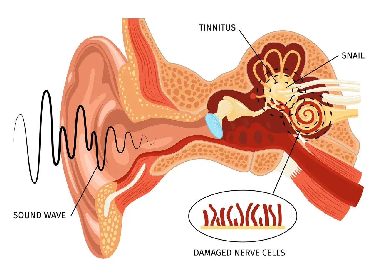 Diagrama del o&iacute;do que muestra c&oacute;mo las ondas sonoras entran y causan zumbido oido por da&ntilde;o en las c&eacute;lulas nerviosas del caracol.