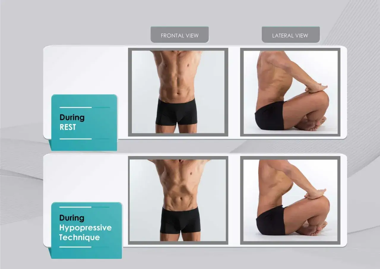 Comparaci&oacute;n de un tronco en reposo y durante la t&eacute;cnica hipopresiva. Se observa la succi&oacute;n abdominal caracter&iacute;stica.