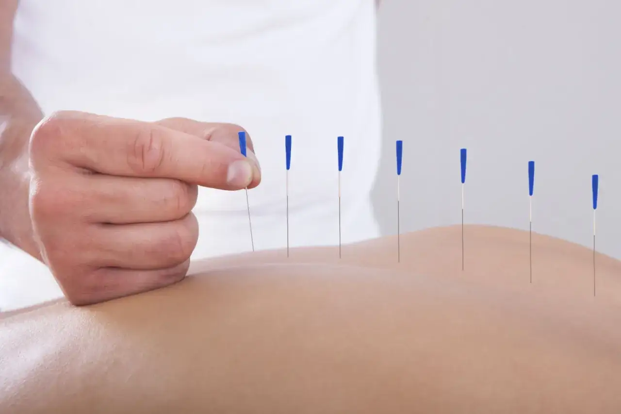 Un terapeuta coloca agujas finas en la espalda de un paciente, ilustrando c&oacute;mo funciona la acupuntura para aliviar el dolor y promover el bienestar.