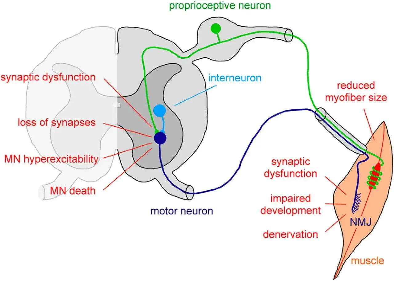 Diagrama de la atrofia muscular espinal, mostrando disfunción sináptica, pérdida de sinapsis y muerte de neuronas motoras.