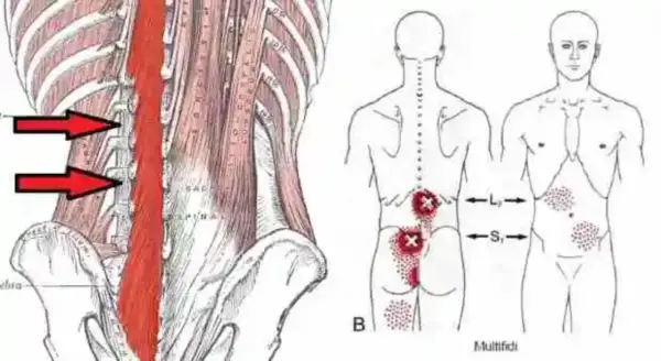 Anatomía de la espalda con flechas rojas señalando la zona afectada por un posible desgarro muscular espalda. Puntos rojos indican dolor.