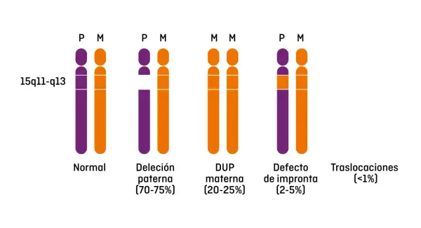 Representación de cromosomas 15q11-q13, mostrando variaciones genéticas asociadas al síndrome de Prader-Willi: normal, deleción paterna, duplicación materna, defecto de impronta y traslocaciones.
