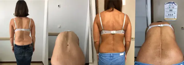 Comparación de la espalda de una mujer antes y después de la corrección de escoliosis. Se puede corregir la escoliosis en adultos.