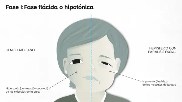 Ilustración comparativa de un rostro con parálisis facial. Un lado muestra un hemisferio sano, el otro un hemisferio con parálisis facial, con hipotonía.