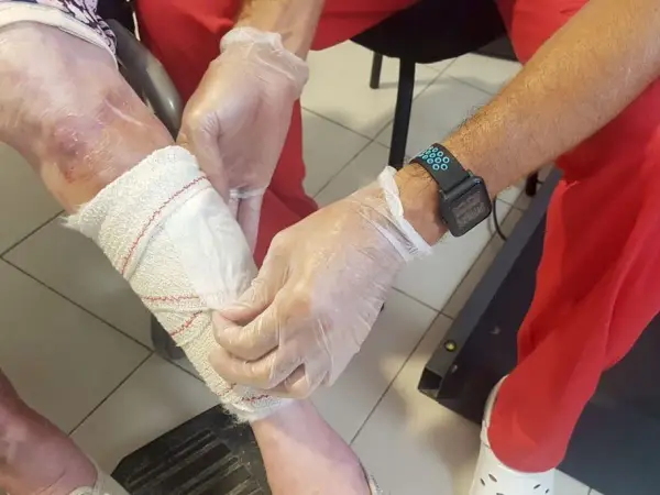 Manos enguantadas vendan pierna con úlceras por presión.